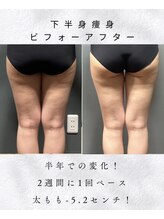 アシュレ リル(assure Lilou)/【痩身】Before→After