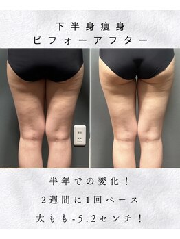 アシュレ リル(assure Lilou)/【痩身】Before→After