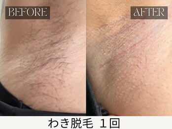 スキンジム(SKIN GYM)/汗蒸れ臭はわき脱毛で解消&予防