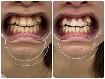 コナホワイトニング 神保町/セルフホワイトニング神保町