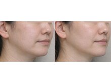 マロン(MARON)/すっきりフエイスライン