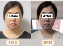 エレグラム(Elegram)/小顔矯正　施術