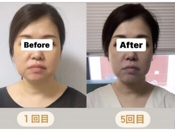 エレグラム(Elegram)/小顔矯正 施術