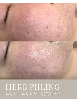 エムネ ラボ 大阪本町(M/NE LAB)/肌荒れやニキビケアにピーリング