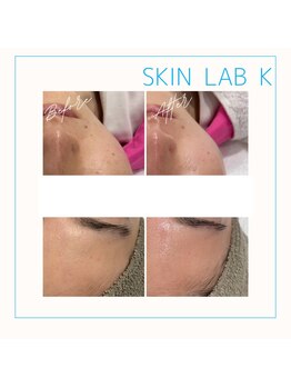 スキン ラボ ケー(Skin lab K)/低温プラズマ＋高濃度美白ケア