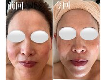 美バストアルファ(美bust α)/【小顔コルギ&バストアップ】