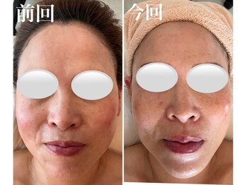 美バストアルファ(美bust α)/【小顔コルギ&バストアップ】