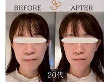 チョコバリ 新宿店(chocobari)/小顔×リフトアップ(美容鍼)20代