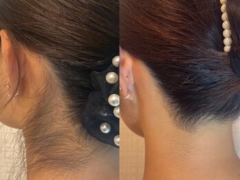 モナートドゥ(Monartdeux)/うなじ脱毛