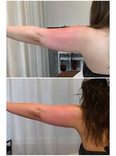 ドゥーソル 谷町四丁目店(due sole)/落ちにくい二の腕