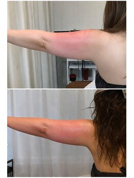 ドゥーソル 谷町四丁目店(due sole)/落ちにくい二の腕