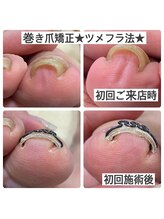 マニュコクーン(ManuCocoon)/爪育成　深爪　巻き爪　大阪市