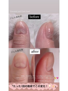 モナールアンド(MONNAL&)/【深爪・トラブル爪】美爪育成