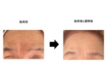 敏感肌の方も使用出来ます♪機械を使わずにここまでシワに効果！