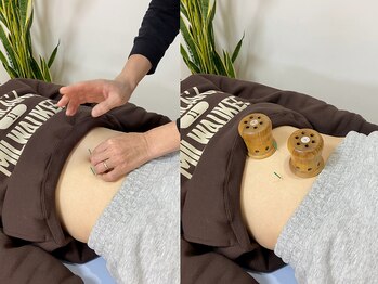 岳鍼灸整骨院の写真/《温灸器を使用した熱くないお灸◎》丁寧なカウンセリング&説明で初めての方も安心！妊活を徹底サポート♪
