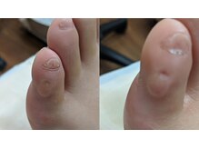 ドクターネイル爪革命 市川店/靴に当たる魚の目