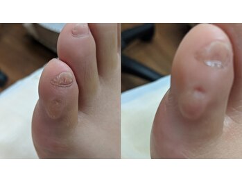 靴に当たる魚の目