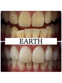 アース(EARTH)/【ビフォーアフター】美白