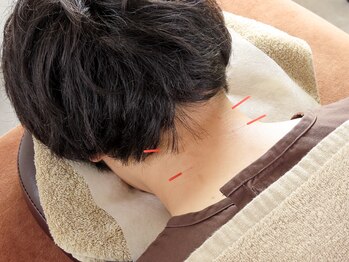 イーライフ鍼灸接骨院/鍼灸施術で深くまで