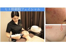 ナトゥーラ チュチュ(natura chuchu)/肌を強くするヒト幹フェイシャル