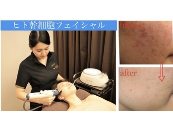 ナトゥーラ チュチュ(natura chuchu)/肌を強くするヒト幹フェイシャル