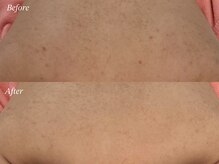 カレンジェビューティー(CarengeBeauty)/背中ニキビ＆毛孔性苔癬