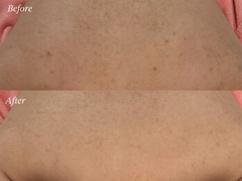 カレンジェビューティー(CarengeBeauty)/背中ニキビ＆毛孔性苔癬