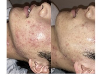 BUB 立川/頑固なニキビケア綺麗にしたい方