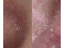 サイ(Sai)/角栓の種類