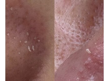 サイ(Sai)/角栓の種類