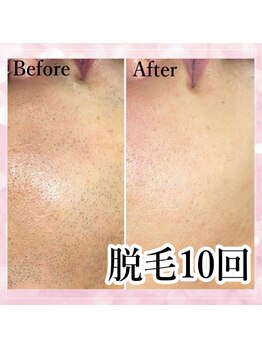 ノーブル(Noble)/メンズ お顔脱毛 10回 効果実績