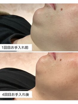 アンドニューリー(&NEWLY)/LDM水玉リフティング小顔コース