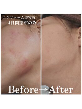 リノ沼津(Lino)/幹細胞美容液での肌荒れ改善