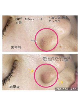 チャームプラス(CHARM+)/【毛穴ケア】