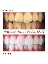 ホワイトニングショップ 高田馬場店/ホワイトニングBefore After
