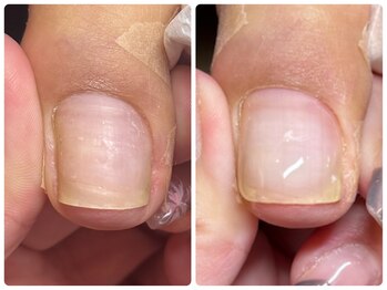 巻き爪ケア（UPジェル）