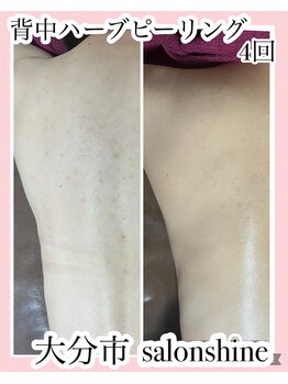 サロンシャイン(Salon Shine)/ハード背中4回