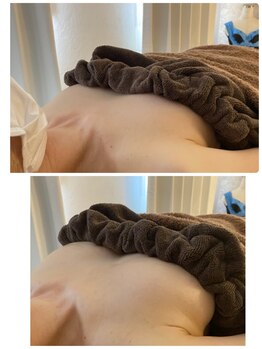 スマイルクルー(SmileClue)/初回ビフォーアフター症例