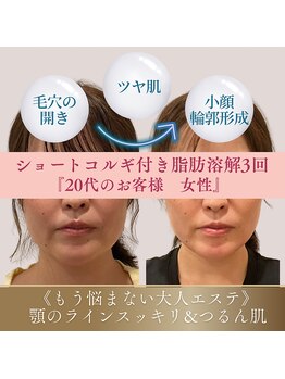 アンシャンテ(Anchant)/【半永久的に脂肪分解】