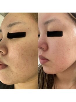 エリシアン ビューティーサロン(Elysian)/ハーブピーリング　