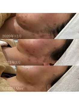 ラ クレール ビューティーサロン(LA CLAIR)/症例(ニキビケア経過)