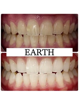 アース(EARTH)/【ビフォーアフター】美白
