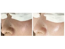 ルル(RuRu)/毛穴洗浄