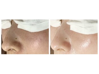 ルル(RuRu)/毛穴洗浄