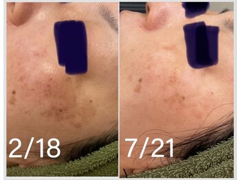 ヴィオラ(Viola)/ハーブピーリングでシミケア