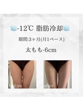 メディカルエステ 恵比寿店/＊脂肪冷却 太もも症例＊