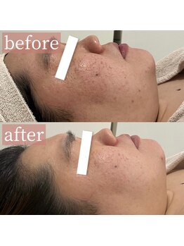 アディクトウラ(Addict'ula)/ラミネーションピール