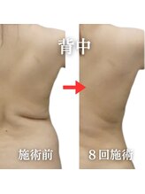 スリムビューティー 立川店/脂肪分解で背中スッキリ美姿勢へ