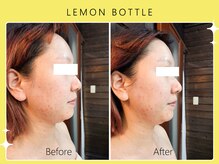 ハノハノ 八代店(HANO HANO)/【八代初導入！】レモンボトル☆