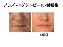 ルアナ(Luana.)の雰囲気（韓国発ダクトピール登場！剥離しないスペシャルコース！）